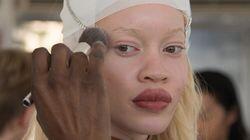 Albinism is just a colour Albinism is just a colour
