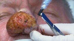 Lessons in Pimple Popping Lessons in Pimple Popping