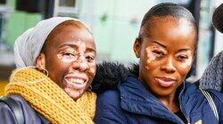 Vitiligo Vitiligo