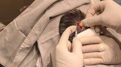 A Head-strong Pilar Cyst A Head-strong Pilar Cyst