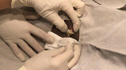 A Little Epidermoid Cyst Never Hurt Anyone A Little Epidermoid Cyst Never Hurt Anyone